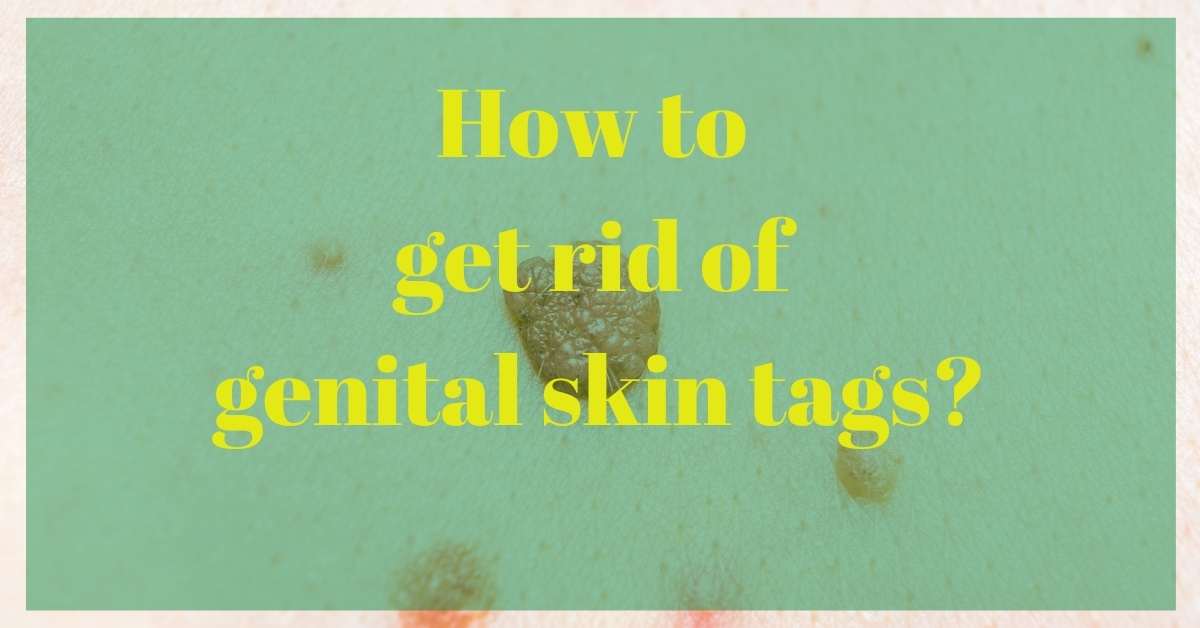 You are currently viewing How to Get Rid of Genital Skin Tags